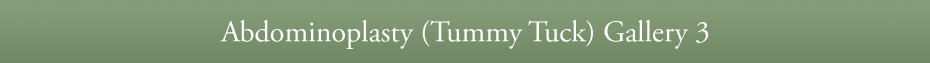Abdominoplasty (Tummy Tuck) Gallery 3