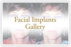 Facial Implants Gallery
